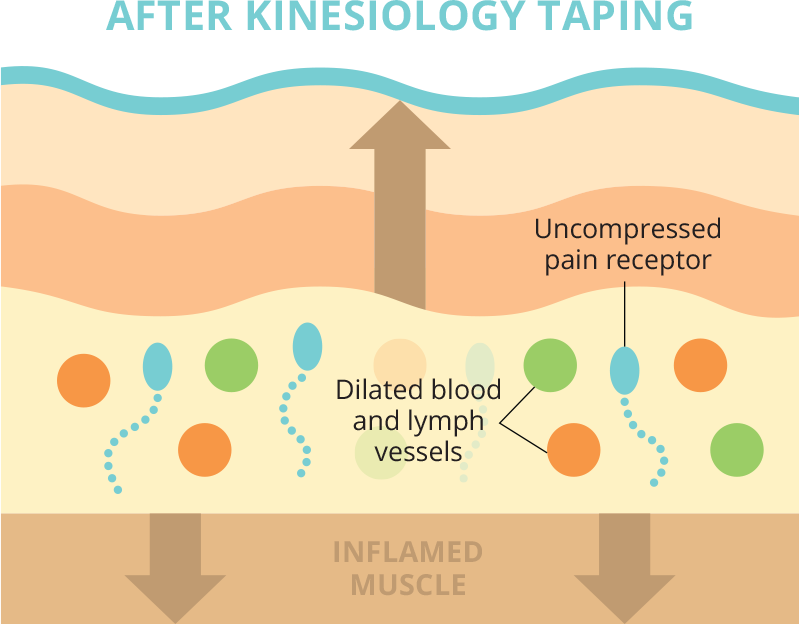 After Kinesio Taping application